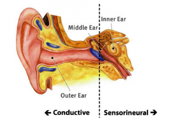 conductive sensorineural hearing loss attorneys